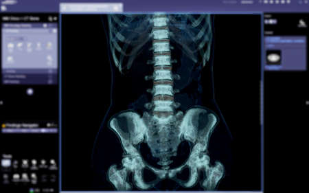 lumbar spine 3D render isolated on medical the screen.の写真素材