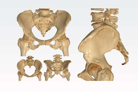 Collection of CT Scan pelvic bone with both hip joint 3D rendering image  isolated on white background.の写真素材