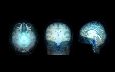 Collection transparent image of the Skull  Blue color with  MRI Brain for medical background concept.の写真素材