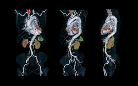 CTA Whole aorta 3D rendering image on black background for detect aortic aneurysm.の写真素材