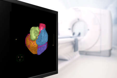Selective focus of CTA artery  3D rendering image on the mornitor in CT Scanner room at the hospital.の写真素材
