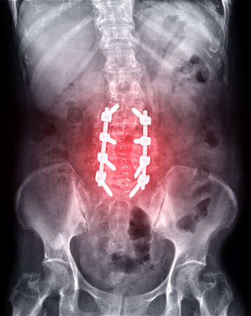 X-ray image of lambosacral spine or L-S spine AP Post operative  Fix Lumbar Plates and screw.