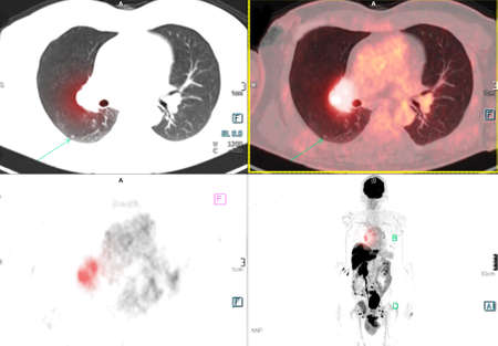 PET Scan image of thorax or chest  Comparison Axial , Coronal  for detect lung cancer recurrence after surgery. medical technology concept.の写真素材
