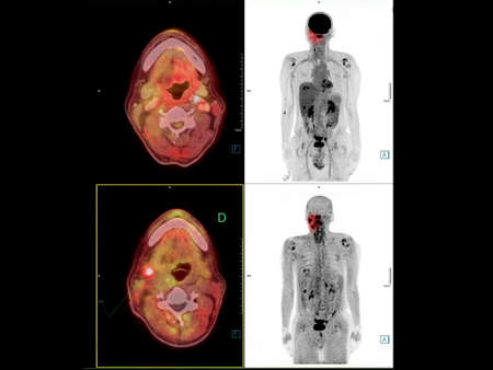 PET CT image of the Neck showing CA nasopharynx or carcinoma of nasopharynx from PET CT scannner.