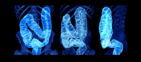 Collection of CT colonography  or CT Scan of Colon 3D Rendering image  showing colon for screening colorectal cancer. Check up Screening Colon Cancer.の写真素材