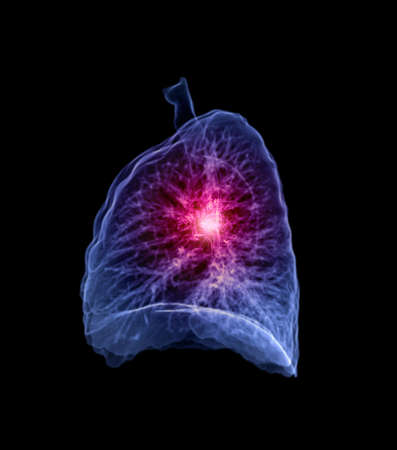 Selective Focus of CT Chest or Lung 3D rendering image left Lateral view showing lesion for...