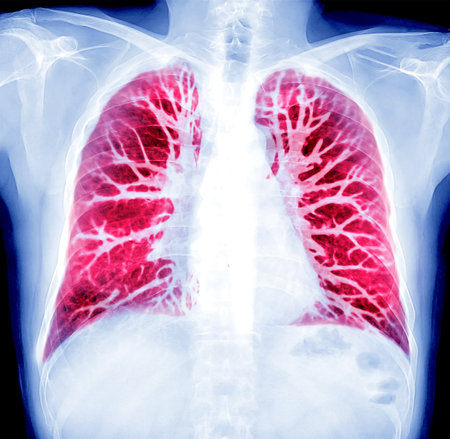 Oil paint effect  of Chest X-ray or X-Ray Image and CT Chest Lung preset for detected  tuberculosis
