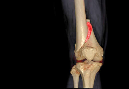CT knee 3D rendering image AP view isolated on black background showing fracture Femur bone.の写真素材