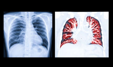 Compare of Chest X-ray or X-Ray Image and CT Chest Lung preset for detected  tuberculosis
Tuberculosis (TB)の写真素材