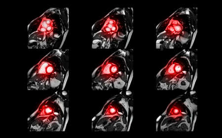 MRI heart or Cardiac MRI magnetic resonance imaging of heart in short axis view showing cross-sections of the left and right ventricle for detecting heart disease.の写真素材