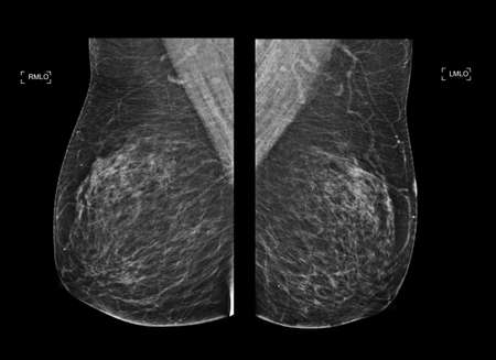 X-ray Digital Mammogram  or mammography  both side of the breast  CC view  for diagnonsis Breast cancer in womenの写真素材