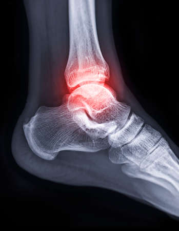 X-ray image of ankle joint showing fracture of ankle joint..の写真素材