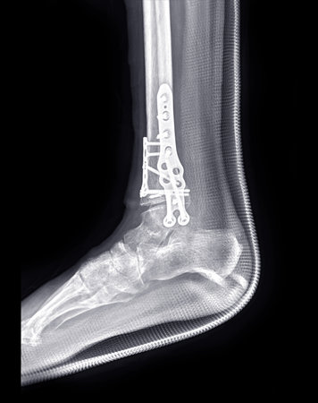 X-ray image of ankle joint showing surgical treatment by internal fixation with plate and screw.の写真素材