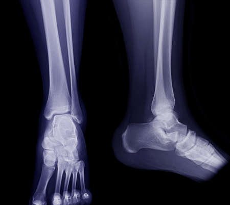 X-ray image of ankle joint AP and Lateral view for diagnosis fracture tibia and fibula bone.の写真素材