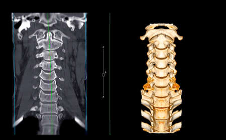 CT SCAN of Cervical Spine ( C-spine ) coronal view and 3D rendering image view in patient trauma case  . Medical technology concept.の写真素材