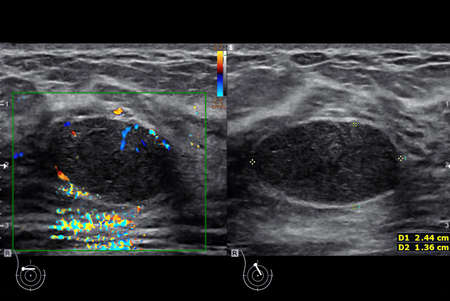 ultrasound  breast of Patient after mammogram  for diagnonsis Breast cancer in women isolated on...
