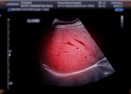 Ultrasound upper abdomen showing  liver.