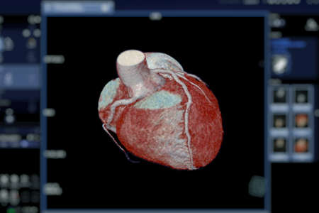 CTA Coronary artery  3D rendering image on the screen  for diagnosis of vessel coronary artery...