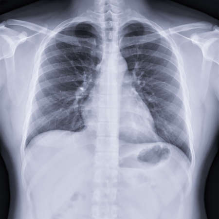 Chest x-ray image for screening diagnosis TB,tuberculosis and covid-19.