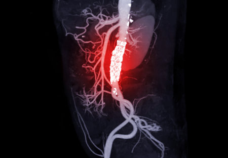 CTA of the abdominal aorta with stent-grafting in patient Abdominal aortic aneurysm.の写真素材