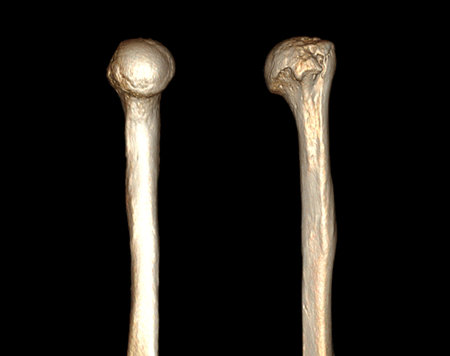 Computed Tomography Volume Rendering examination of the shoulder joint and humerus bone 3D rendering in patient fracture shoulder joint and humerus bone .の写真素材