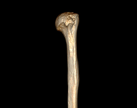 Computed Tomography Volume Rendering examination of the shoulder joint and humerus bone 3D rendering in patient fracture shoulder joint and humerus bone .の写真素材