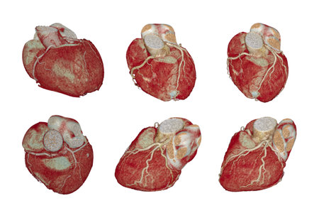 CT Cardiac 3D or CTA coronary artery for prevention coronary artery diseases isolated on black background.Clipping path.の写真素材