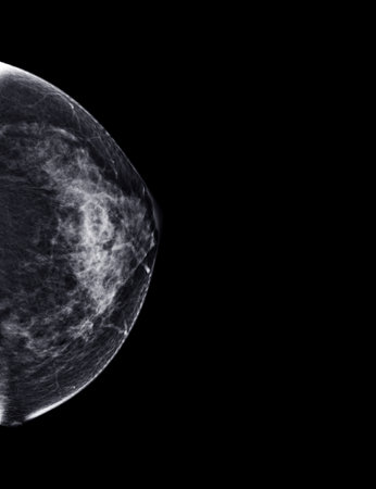X-ray Digital Mammogram or mammography of both side breast Standard views are bilateral craniocaudal (CC)   for  screening Breast cancer and evidence of malignancy .の写真素材