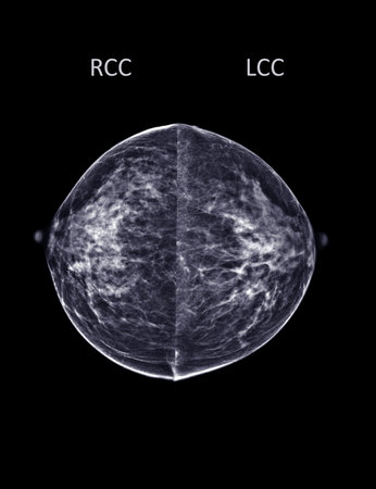 X-ray Digital Mammogram or mammography of both side breast Standard views are bilateral craniocaudal (CC)   for  screening Breast cancer and evidence of malignancy .の写真素材