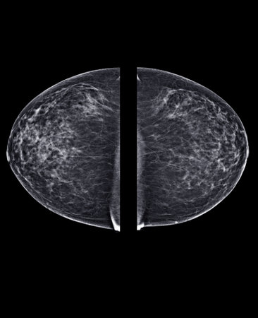 X-ray Digital Mammogram or mammography of both side breast Standard views are bilateral craniocaudal...