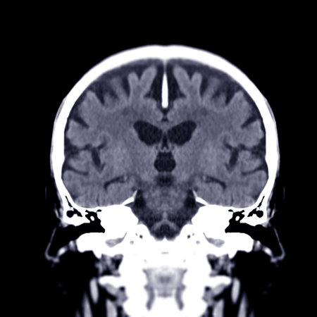 CT scan of the brain Coronal view  for diagnosis brain tumor,stroke diseases and vascular diseases.