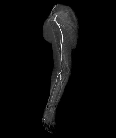 CTA brachial artery or CT scan of upper extremity  3D rendering image .