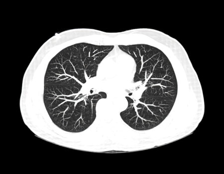 CT scan of Chest or lung  axial view at radiology department in hospital. Covid-19 scan body xray test detection for covid virus epidemic spread conceptの写真素材