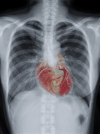 Fusion image of  Chest X-ray image  and 3D CTA Coronary artery  for screening diagnosis...