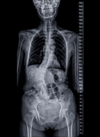X-ray image of Whole  Spine  for diagnosis scoliosis of spine.の写真素材