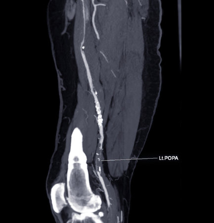 CTA femoral artery run  off MPR curve  showing Left  femoral artery for diagnostic  Acute or Chronic Peripheral Arterial Disease.の写真素材