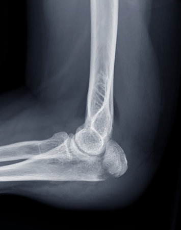 X-ray of Elbow join showing  fracture of ulna bone.の写真素材
