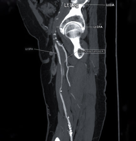 CTA femoral artery run  off MPR curve  showing Left  femoral artery for diagnostic  Acute or Chronic Peripheral Arterial Disease.
