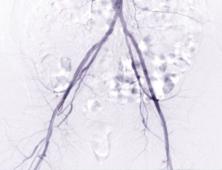 Femoral artery angiogram or angiographyの写真素材