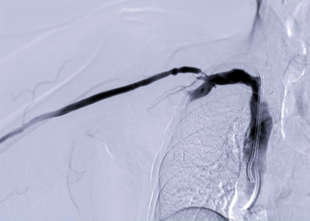 Image of Angioplasty, balloon angioplasty and percutaneous transluminal angioplasty (PTA) .の写真素材