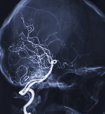 Cerebral angiography  image from Fluoroscopy in intervention radiology  showing cerebral artery.の写真素材