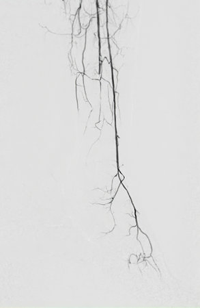 Femoral artery angiogram or angiography  at lower extremity area.