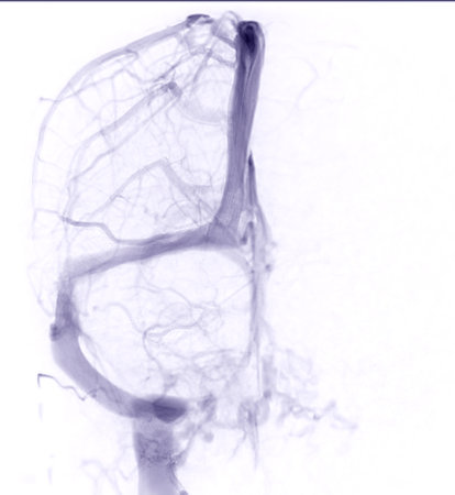 Cerebral  Venograpgy for diagnosisi Cerebral Venous Thrombosisの写真素材