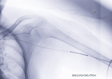 Angioplasty, balloon angioplasty and percutaneous transluminal angioplasty (PTA) on Left arm.の写真素材