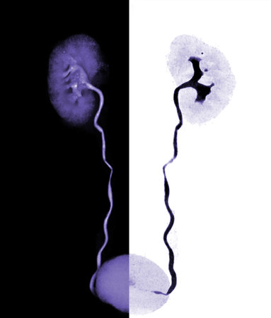 CTA Renal artery  3D rendering image  showing both kidney, Ureter and bladder .の写真素材