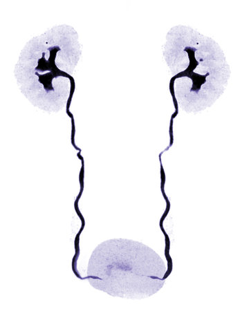 CTA Renal artery  3D rendering image  showing both kidney, Ureter and bladder .
