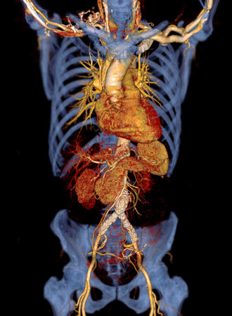 CTA of the aorta with stent-grafting in patient Abdominal aortic aneurysm.の写真素材