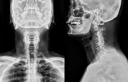 X-ray C-spine or x-ray image of Cervical spine AP and Lateral view for diagnostic intervertebral...