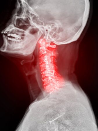 X-ray C-spine or x-ray image of Cervical spine lateral view for diagnostic intervertebral disc...
