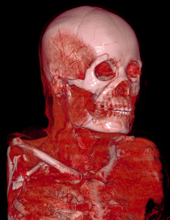 CTA brain and carotid artery or CT angiography of the brain  3D Rendering image .の写真素材